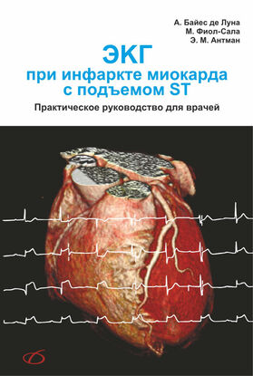 ЭКГ при инфаркте миокарда с подъёмом ST